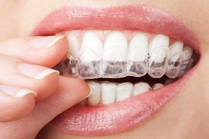 Invisalign® für Erwachsene in Berlin-Lichterfelde – Unsichtbare Zahnkorrektur